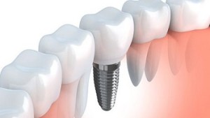 Restorative Dental Procedures