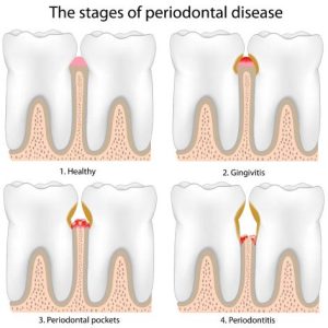 Understanding Periodontics