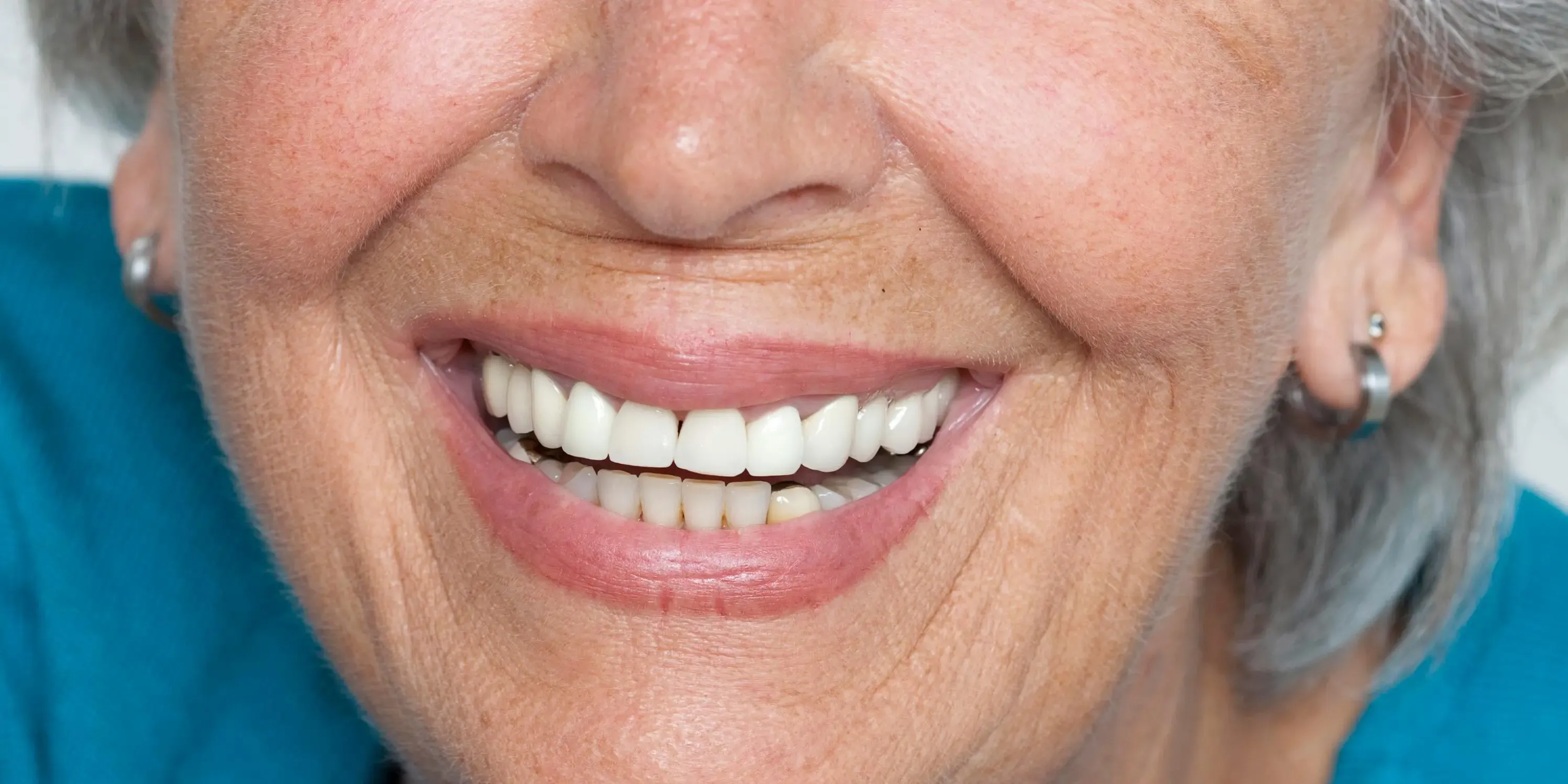 What is Invisalign Treatment? Everything You Need to Know