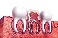 Root Canal For Better Long-Term Dental Health 
