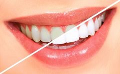 How to Make Teeth Whitening Last Longer?