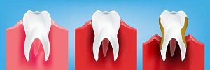 May indicate that there is Indeed Gum Disease Present